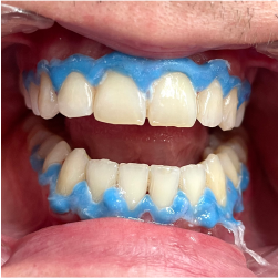 Избељивање зуба,17 јула 2023., Дуња стоматолог